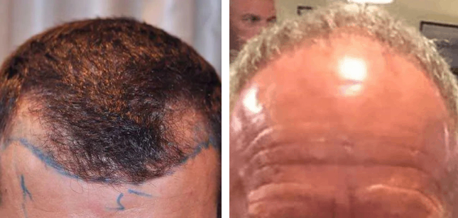 messed up hairline from male pattern baldness