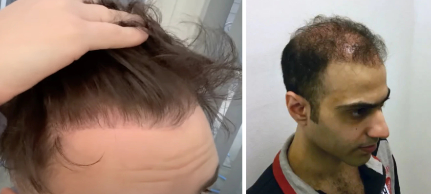 bad hair transplant