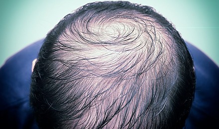 My Hair Is So Thin I Can See My Scalp