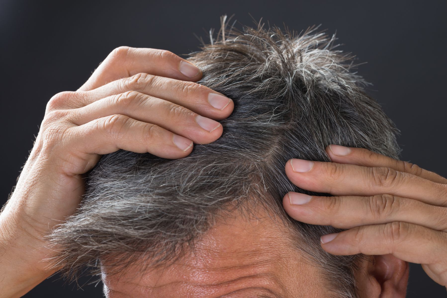 Does saw palmetto work for all types of hair loss?