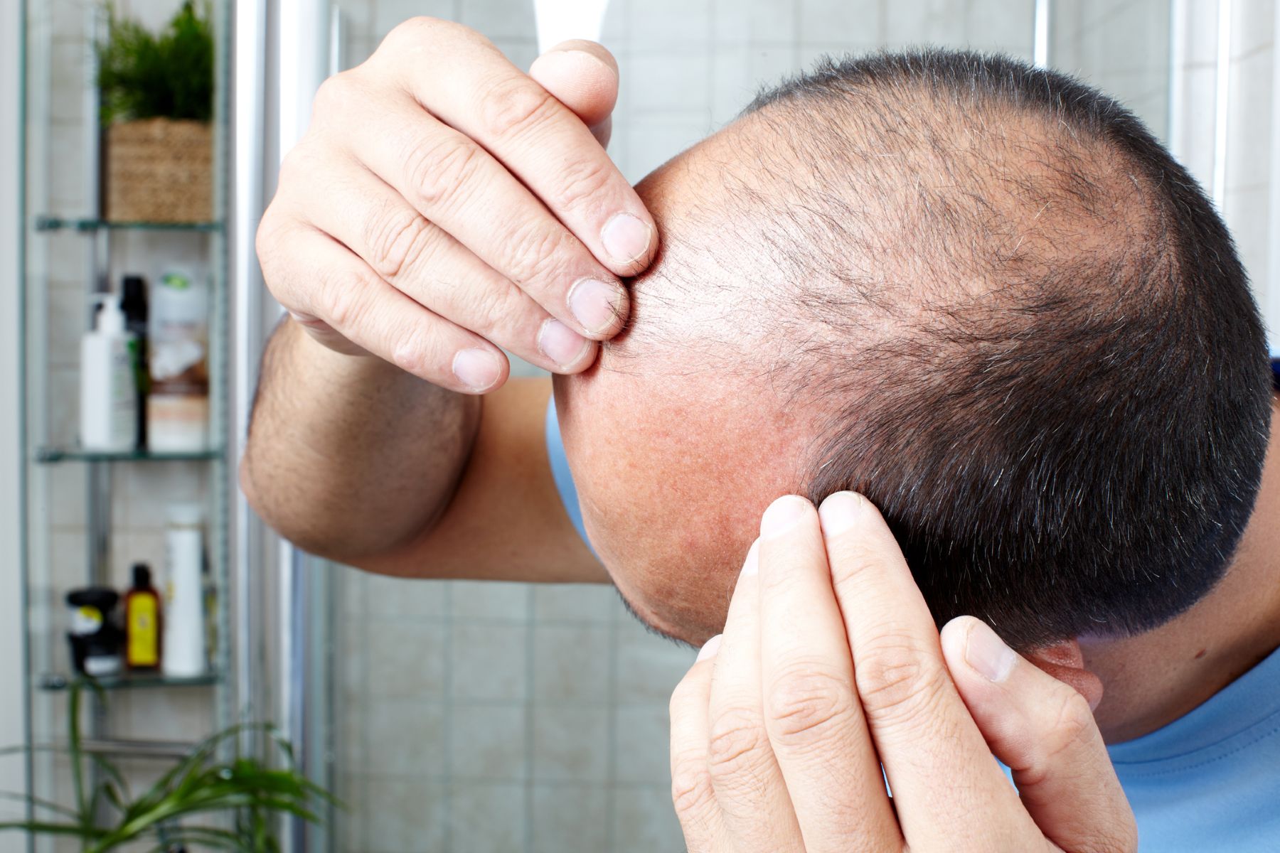 How can I avoid going bald?