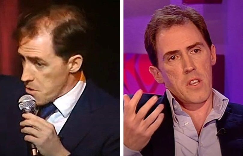 Rob Brydon's hair loss