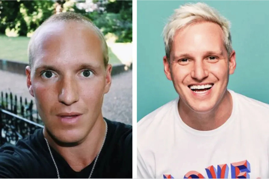 Jamie Laing Hair Transplant Before And After