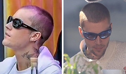 Justin Bieber Hair Transplant