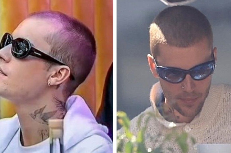 Justin Bieber Hair Transplant