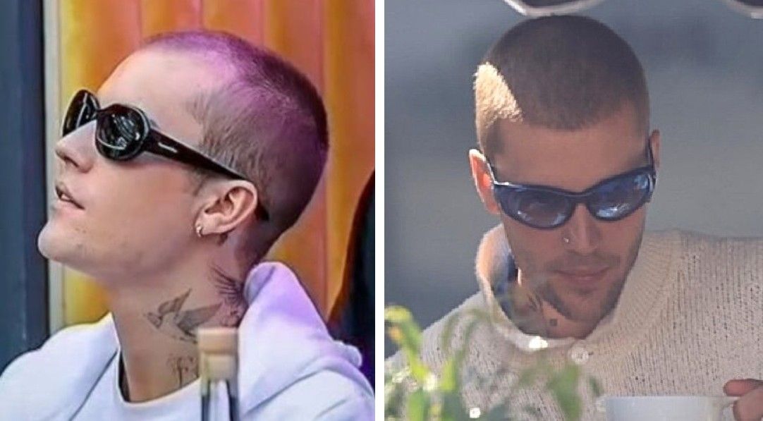 Justin Bieber hair transplant
