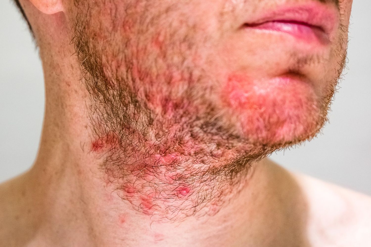 Seborrheic dermatitis