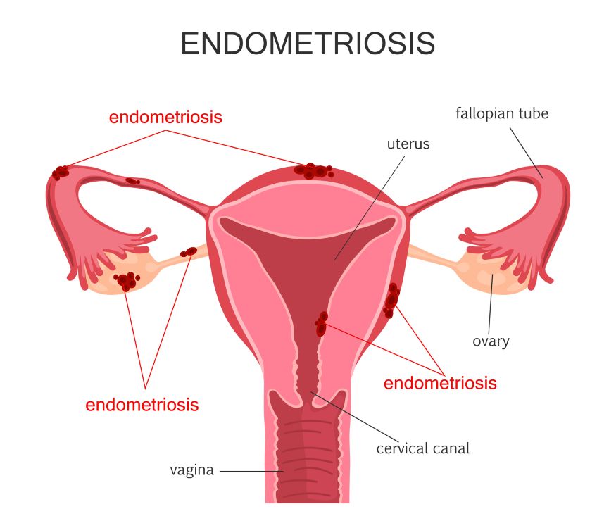 What is endometriosis?