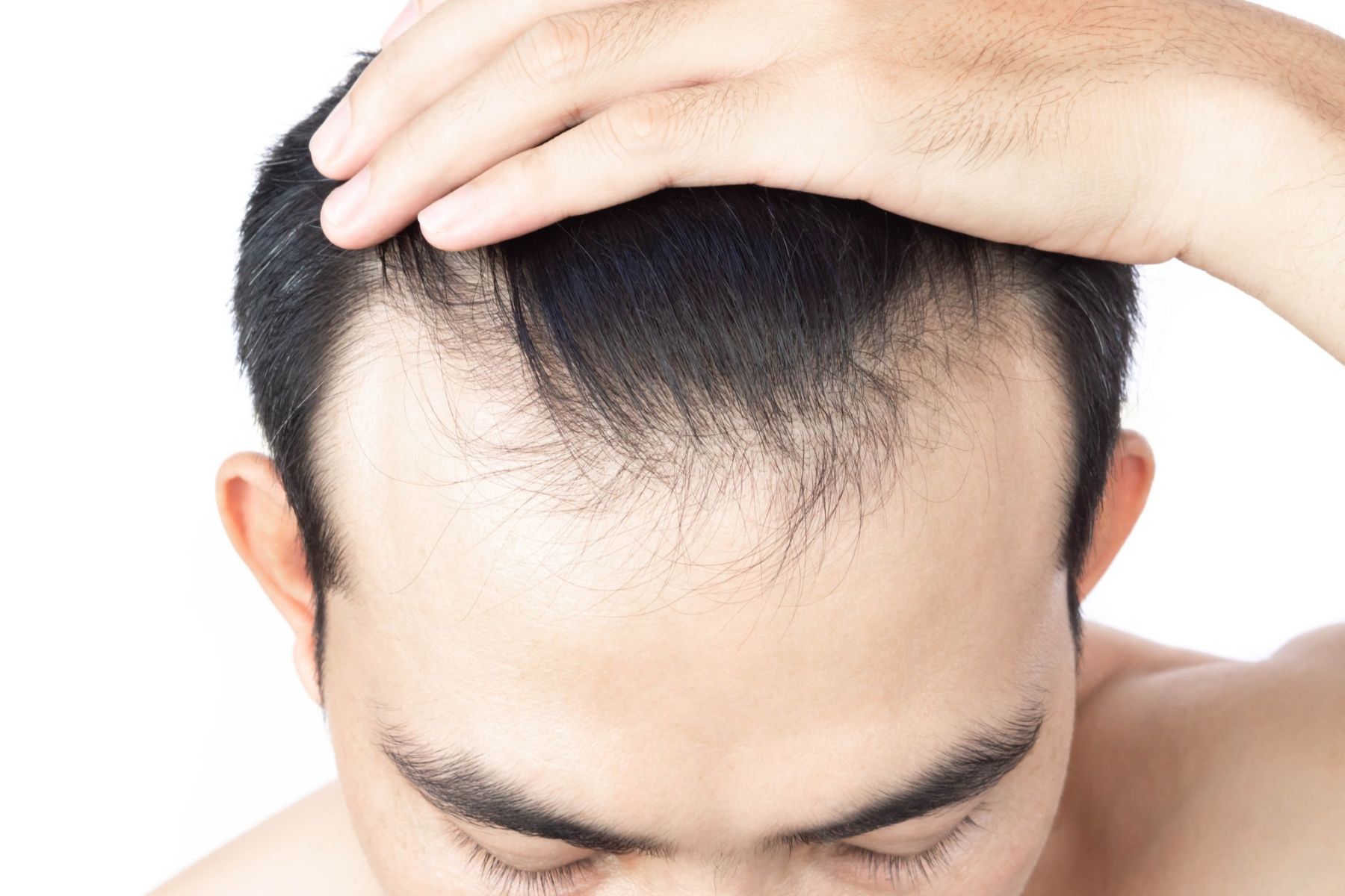 man with thin hair in front