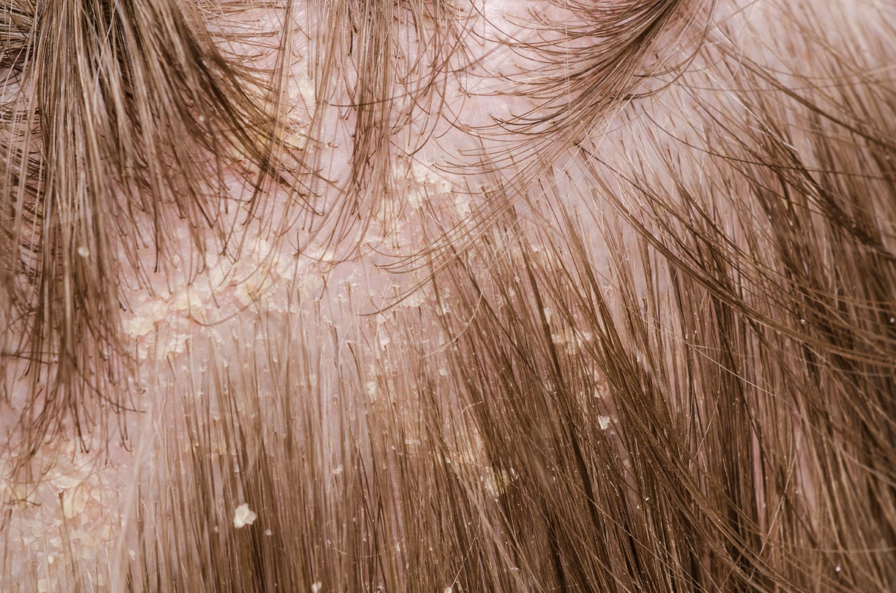 Apple cider vinegar treats dandruff