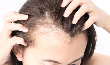 Female Hair Loss At Temples