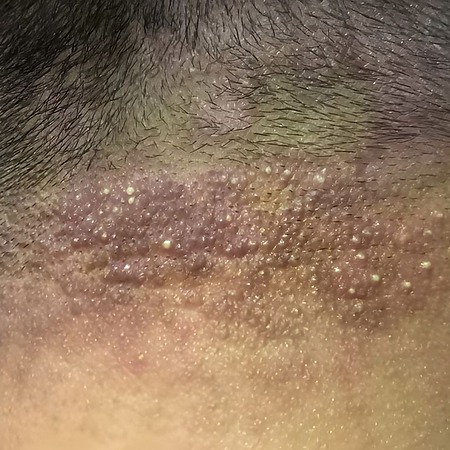 Folliculitis pustules