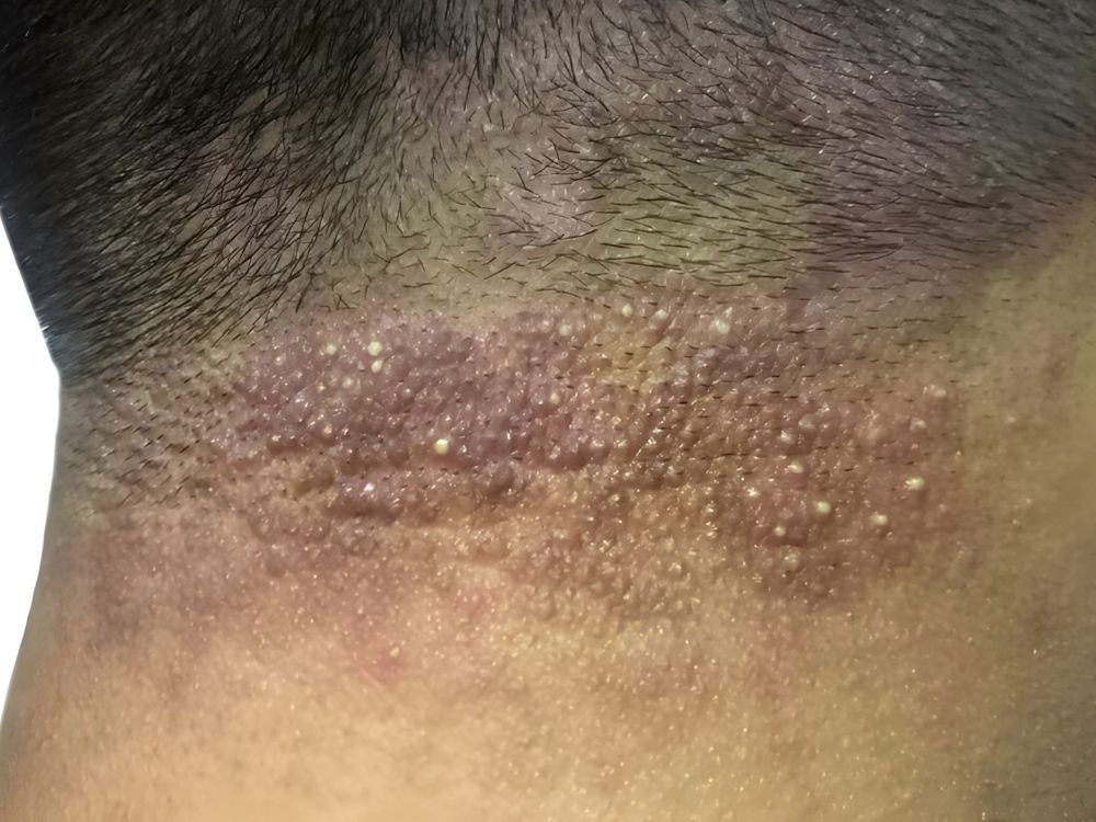 scalp folliculitis