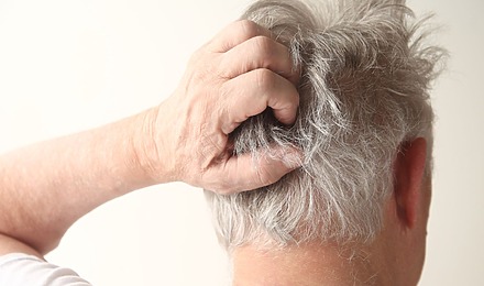 NHS Seborrheic Dermatitis