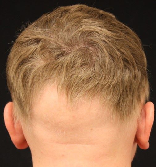 Ophiasis Alopecia: Causes, Symptoms And Treatments