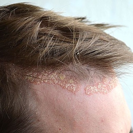 Psoriasis on the frontal hairline