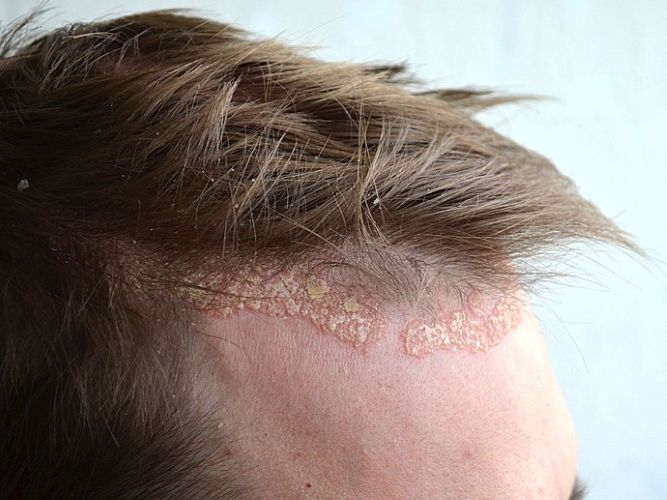 scalp psoriasis on the frontal hairline