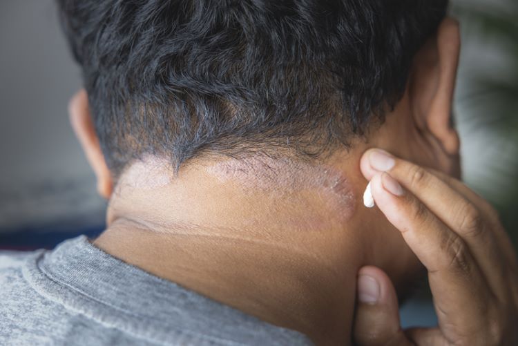 male patient with scalp eczema