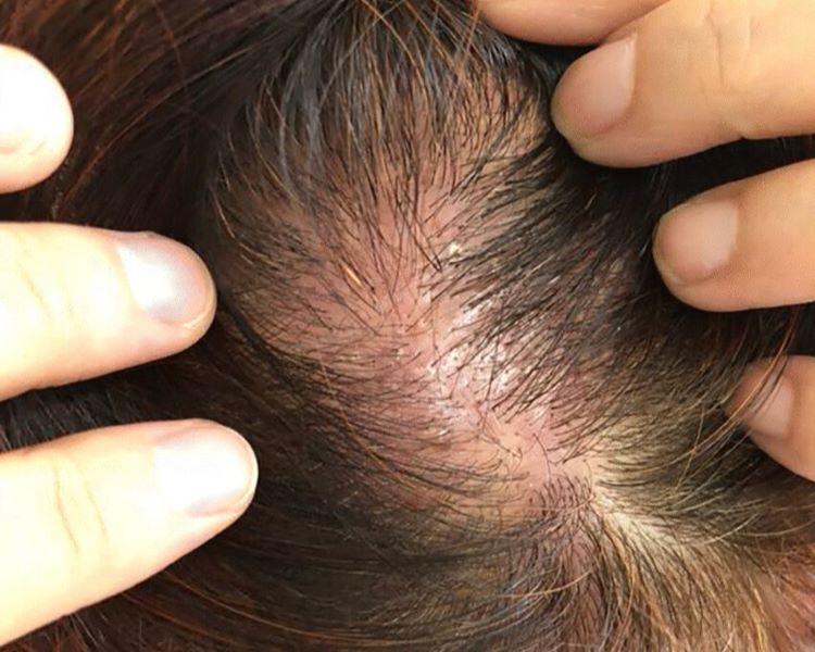 Contact dermatitis (allergic reaction)