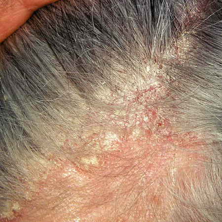 Seborrheic dermatitis on the scalp