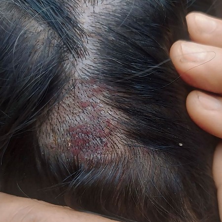 ring worm on the scalp