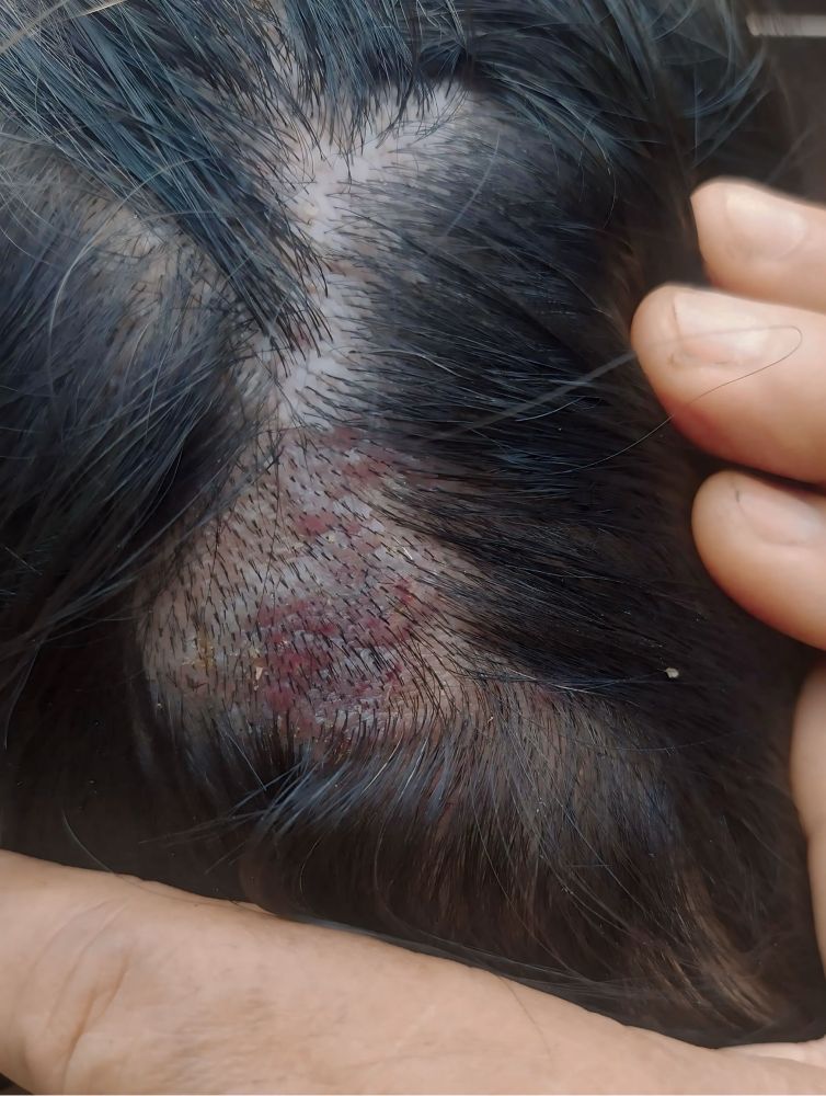 ring worm (tinea capitis) on the scalp