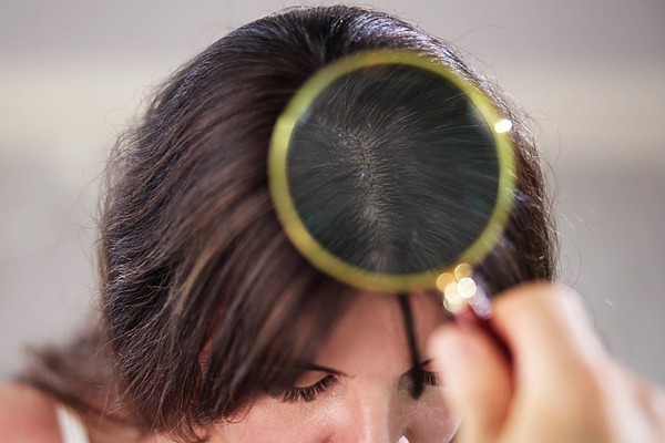 Can A Dry Scalp Cause Hair Loss
