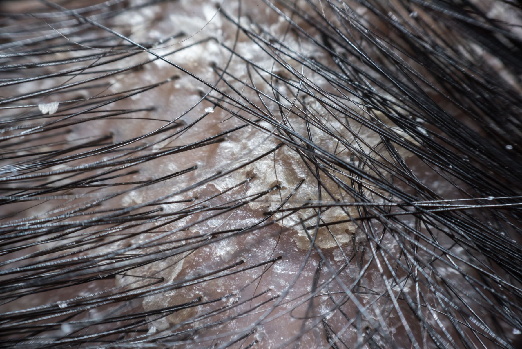 dry and flaky scalp