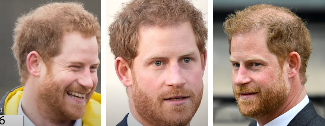 Prince Harry Hair Transplant &ndash; Everything You Need To Know