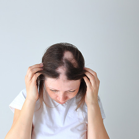 alopecia areata in young woman