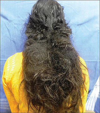 Matted hair