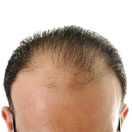receding hairline
