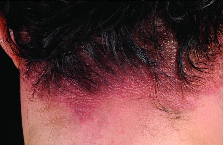Contact dermatitis at the base of the scalp