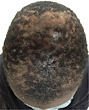 Central centrifugal cicatricial alopecia
