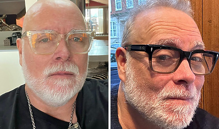 Gary Goldsmith Hair Transplant