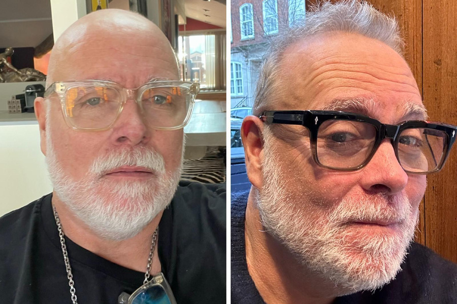 Gary Goldsmith Hair Transplant