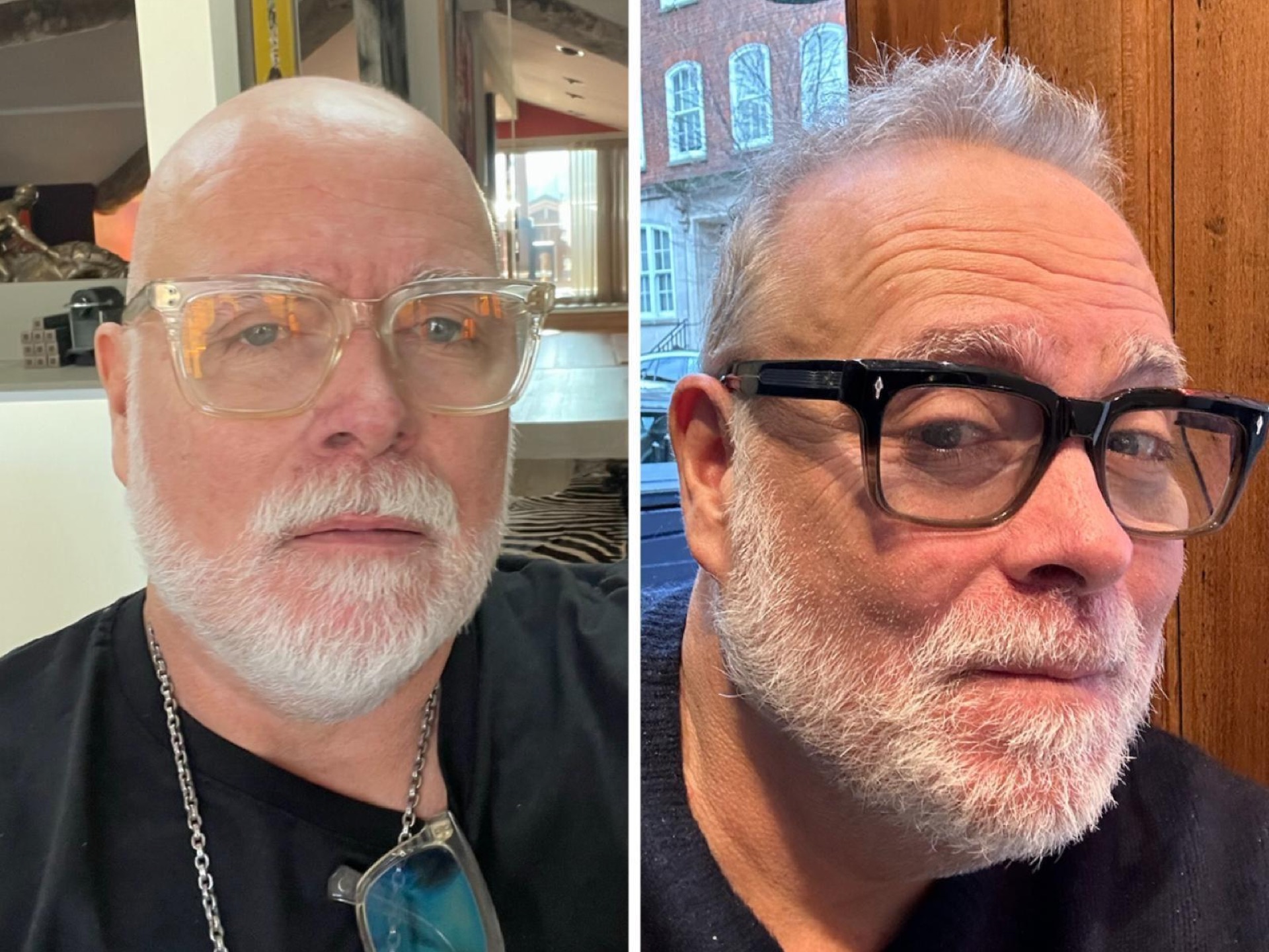 Gary Goldsmith&rsquo;s Hair Transplant &ndash; Everything you Need to Know