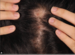 Trichotillomania