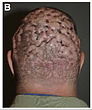 Central centrifugal cicatricial alopecia