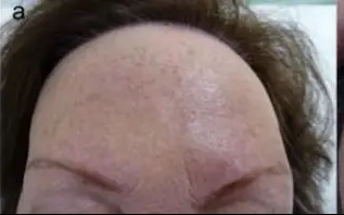 frontal fibrosing alopecia