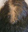 telogen effluvium