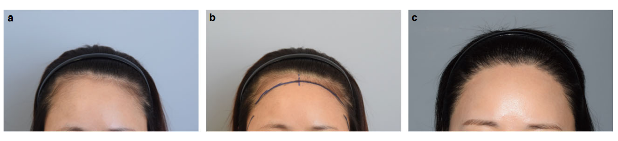 Woman before and after forehead hair transplant