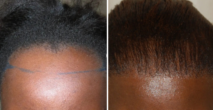 woman before and after a forehead hair transplant