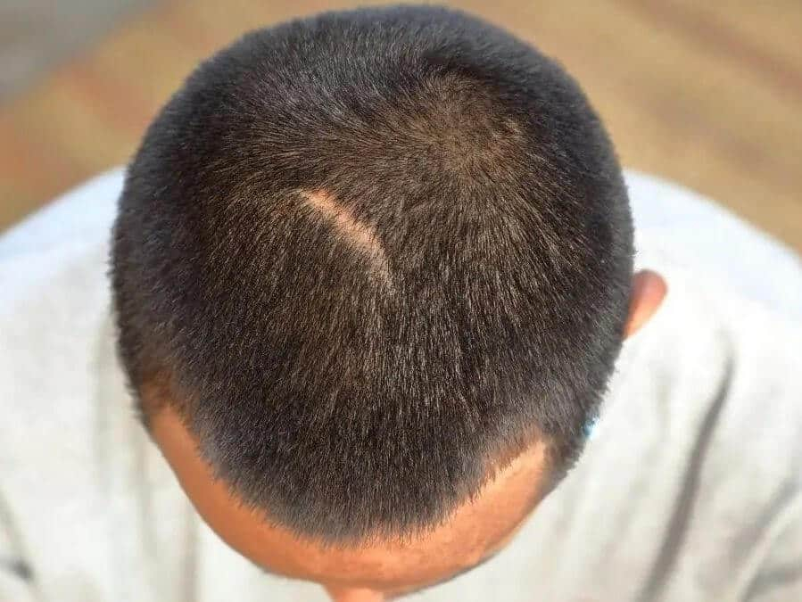 Bald spot on scalp from scarring