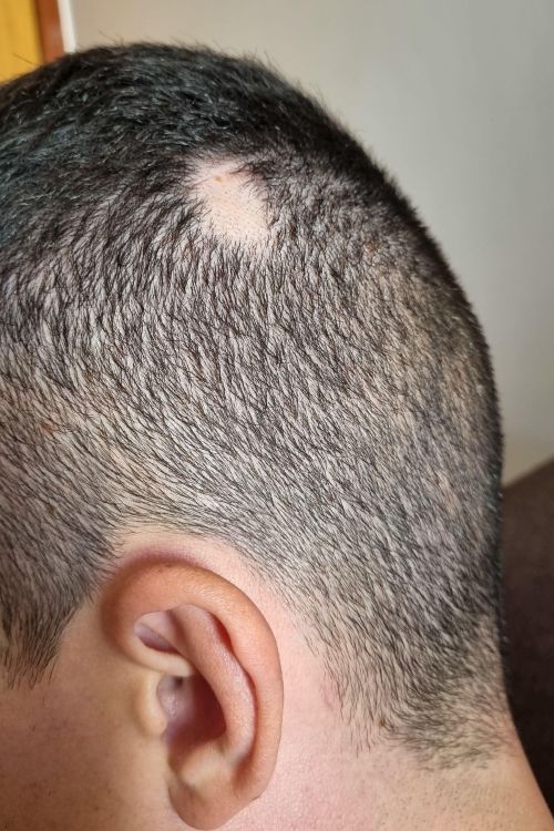 Bald spot from alopecia areata
