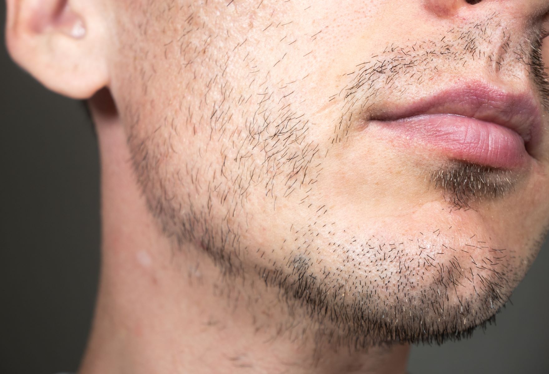 Man with a genetically patchy beard growth
