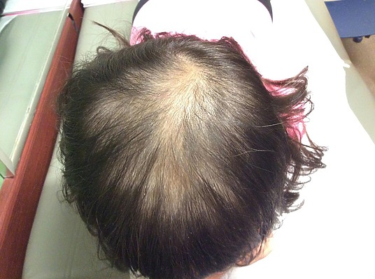 Thyroid Hair Loss: How To Spot Its Signs and Reverse It