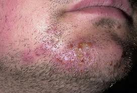 Patient with tinea barbae (beard ringworm)