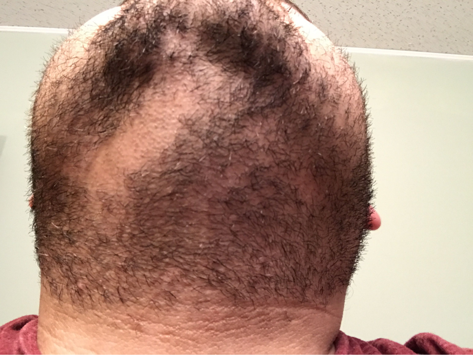 Man with trichotillomania of the beard