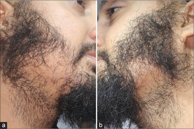 Man with bilateral traction alopecia of the beard